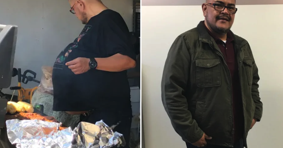 This Mans “beer Belly” Turned Out To Be A 77 Pound Tumor 
