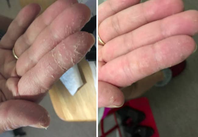 before/after of reviewer hands with less cuts and dry skin after using cream