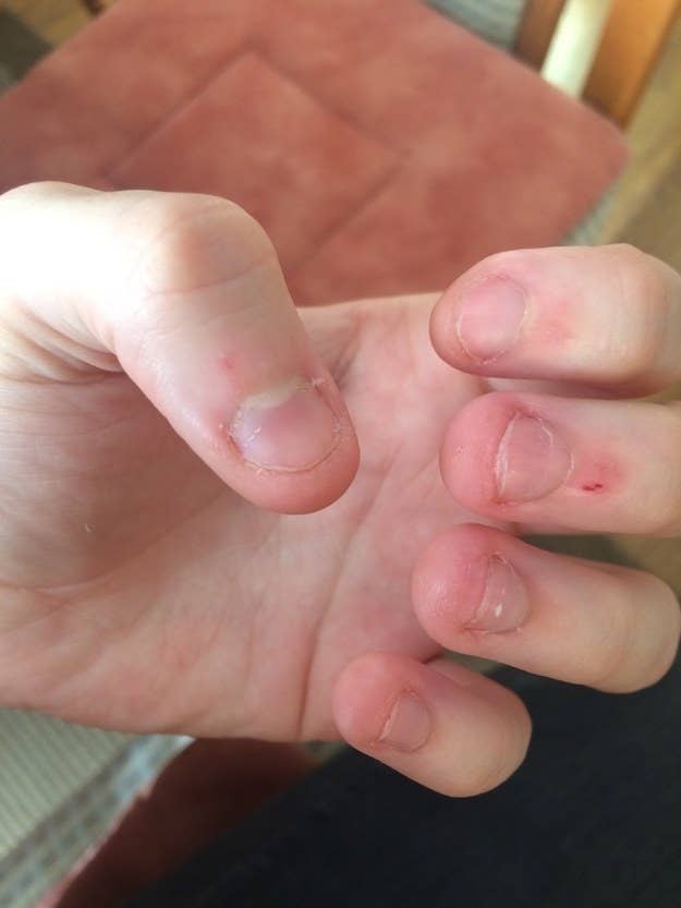 How Did You Stop Picking Or Biting Your Nails?