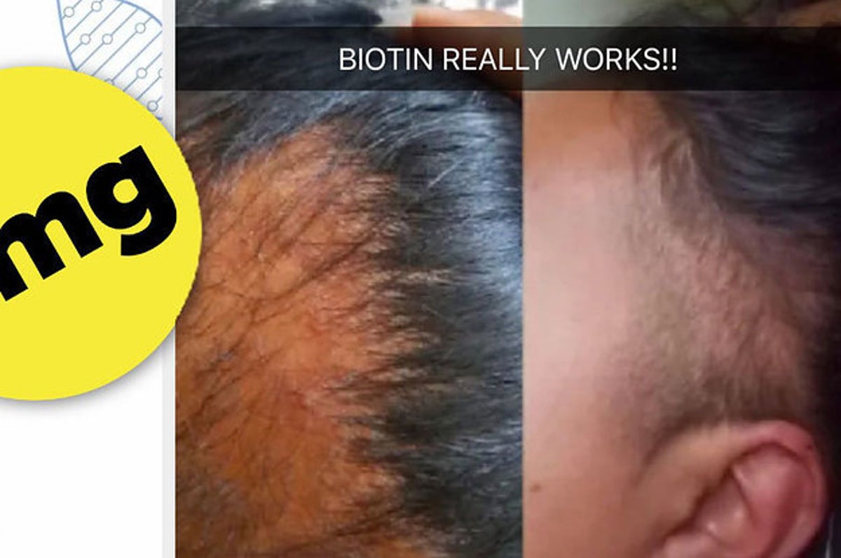 This Biotin Shampoo's Before And After Photos Will Have You Believing In  Miracles