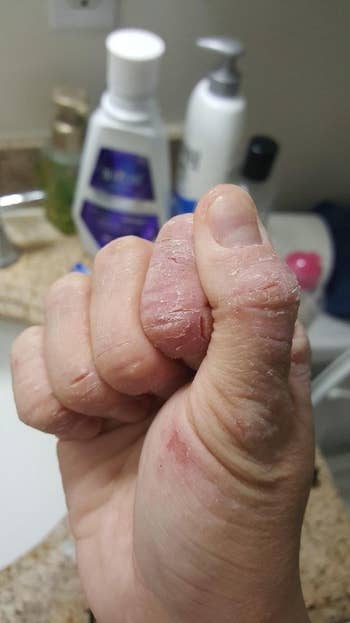 A reviewer's hand looking flaky, chapped and super dry