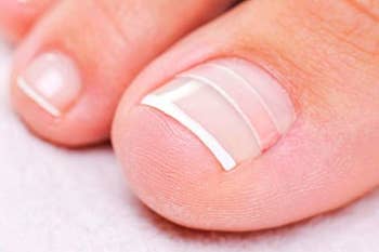 the brace strip on a toe nail