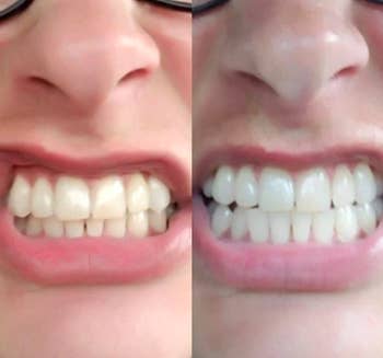 A customer's before and after when using the toothpaste