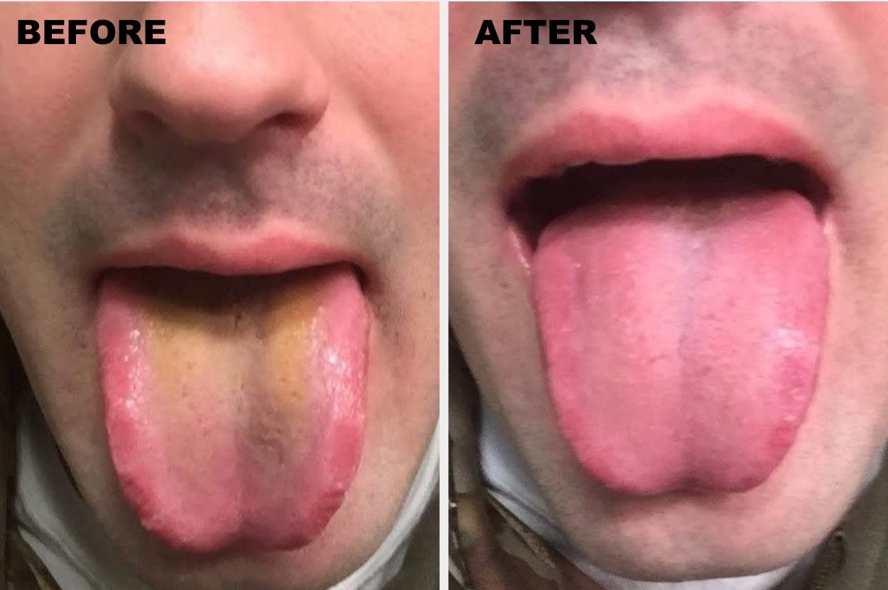 Promising review: "Unfortunately, I — like many others — suffer from bad breath and have tried so many things to get rid of it. I read that sometimes it's the germs on your tongue that can cause it, so I went crazy trying to brush my tongue. Of course we all know how that ends — gagging, watery eyes, and it still looks like that gross residue is on your tongue. I finally decided that it was time to get a tongue cleaner and it had to be a stainless steel one because they are easier to clean and sterilize. This product is really easy to use and I can get very far back on my tongue without activating my gag reflex. This cleaner just glides across my tongue, taking all the icky germs and bad breath with it. I really like this product and love that it came with a travel case, but not more than than my new fresh breath and bolster of confidence!" —jordanlaurenGet it from Amazon for $6.02.