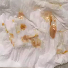 Tissue covered in brown buildup and saliva from tongue 