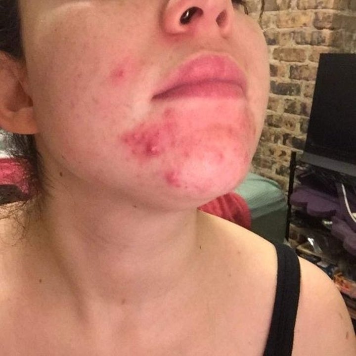 23 Ways To Get Clear Skin And Keep It That Way