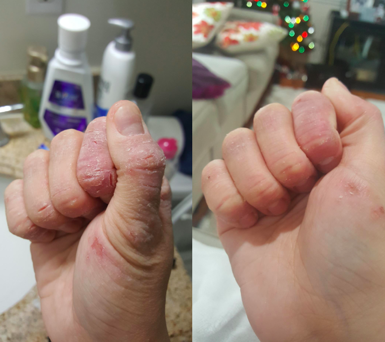 reviewer&#x27;s dry cracked hands and then healed hands after using the cream