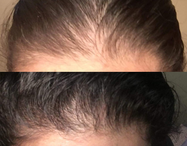 Mua ELEVATE Derma Roller Natural Biotin Hair Growth Oil Serum & Scalp  Massager Brush to Stimulate Hair Regrowth for Thicker Stronger Hair for Men  & Women – Hair Loss Treatment Kit trên