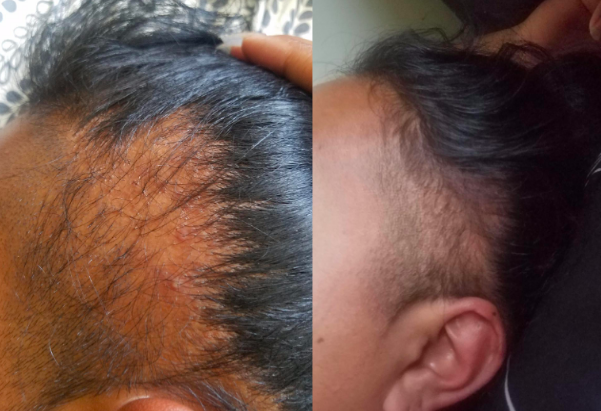Biovita Essentials Biotin + Hair Food Theraputic Hair Regrowth Serum 2