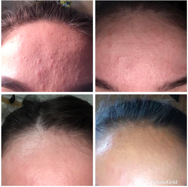 A series of customer review photos showing their forehead before and after using the toner