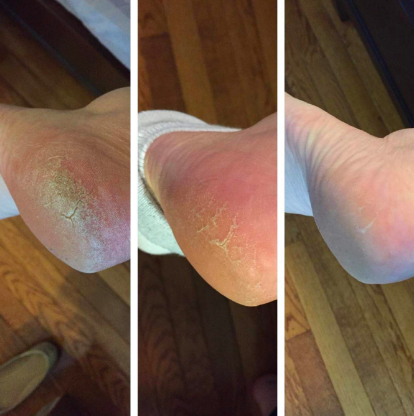 A before-and-after review image showing a severely dry heel, the same heel with less dryness and peeling skin, and the heel with almost no dryness or peeling skin