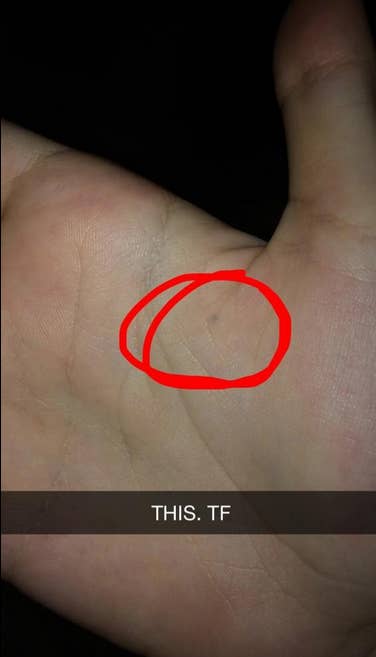 If You Were Stabbed By A Pencil And Still Have A Mark You Are Not Alone