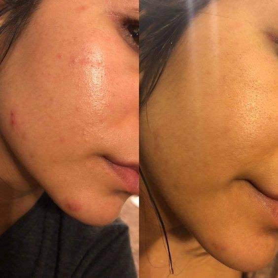 On left, reviewer&#x27;s cheek and chin with redness and breakouts. On right, same cheek and chin with less skin irritation