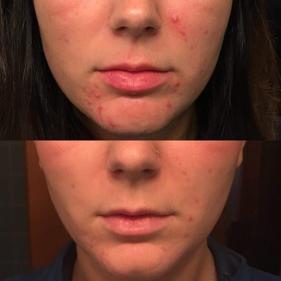 a reviewer&#x27;s before and after photo which shows inflamed pimples and then much less noticeable pimples