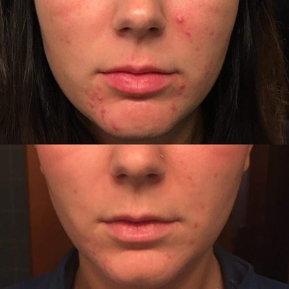 a reviewer's before and after photo which shows inflamed pimples and then much less noticeable pimples