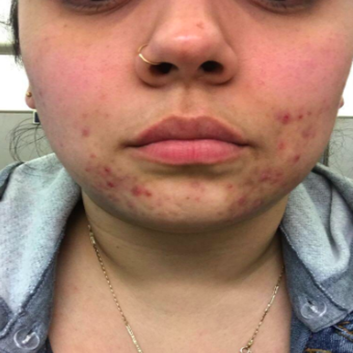 a reviewer's before photo which shows redness and acne around their mouth and chin