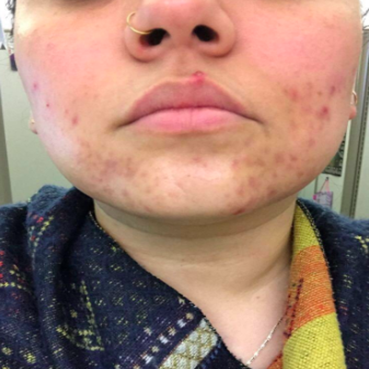 reviewer's after photo which shows the mask reduced redness and inflammation
