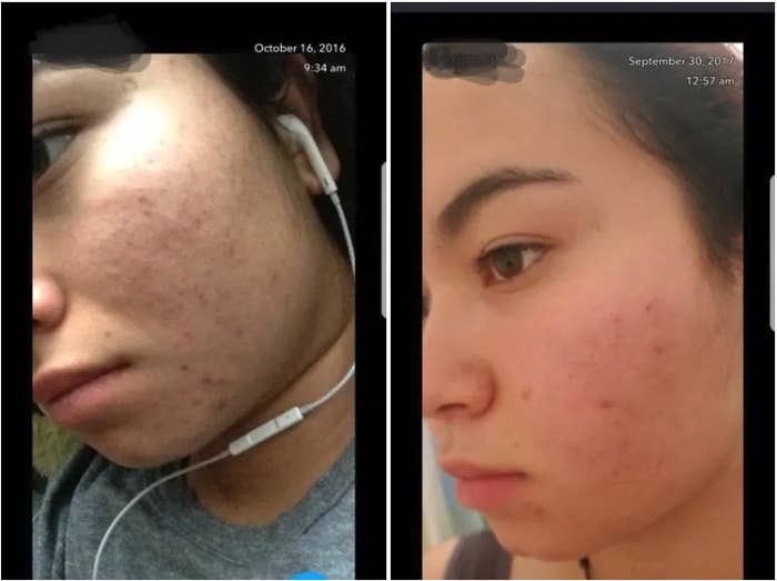 Acne Treatment 30 Year Old Woman