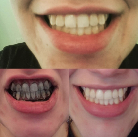 a sequence of images showing the use of the product and the teeth getting whiter after use