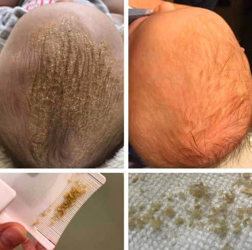 Reviewer pic of a baby's scalp with cradle cap and then without