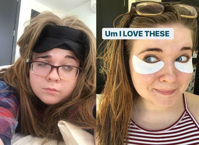 BuzzFeed editor eyes before and while using under eye patches