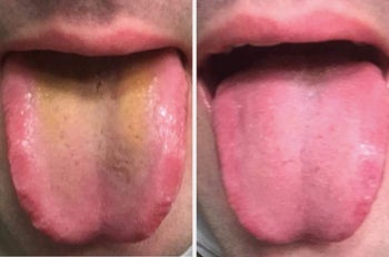 Reviewer pic of their yellow tongue and then pink after using the scraper