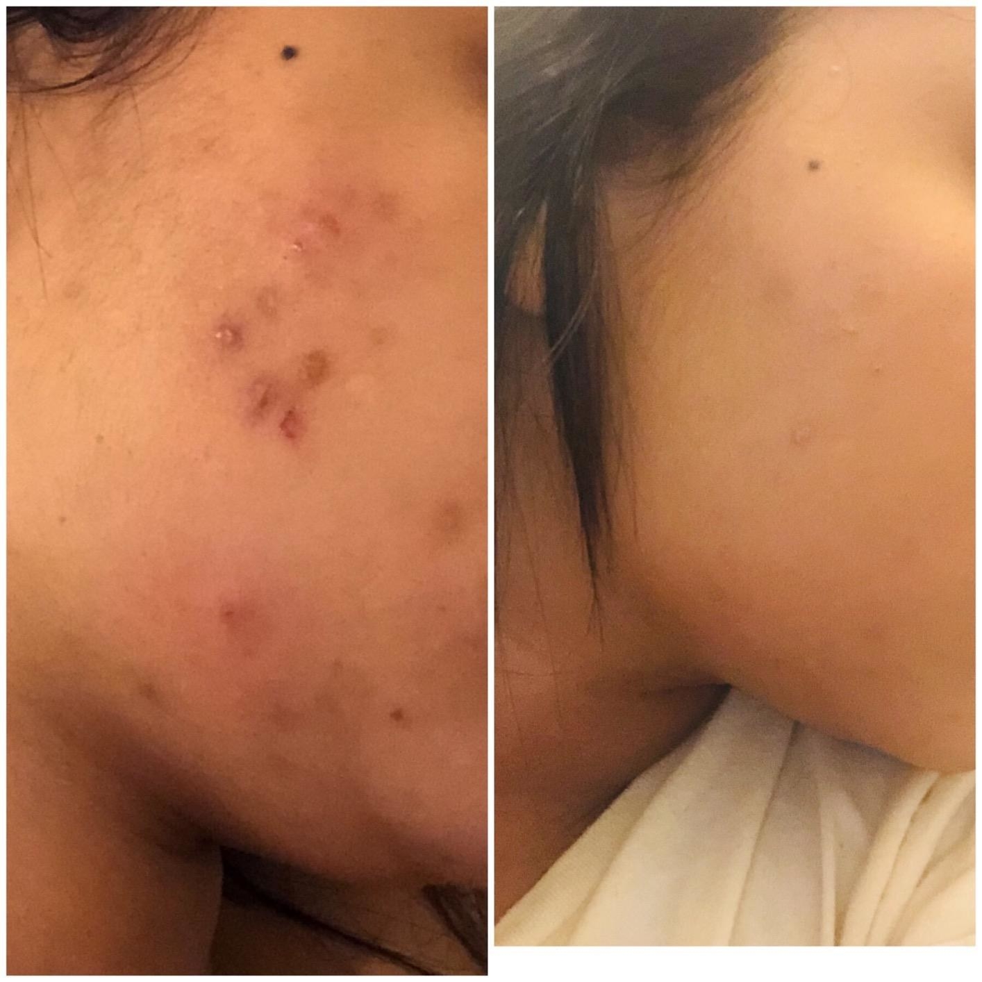 A reviewer&#x27;s before/after showing healed cheek acne