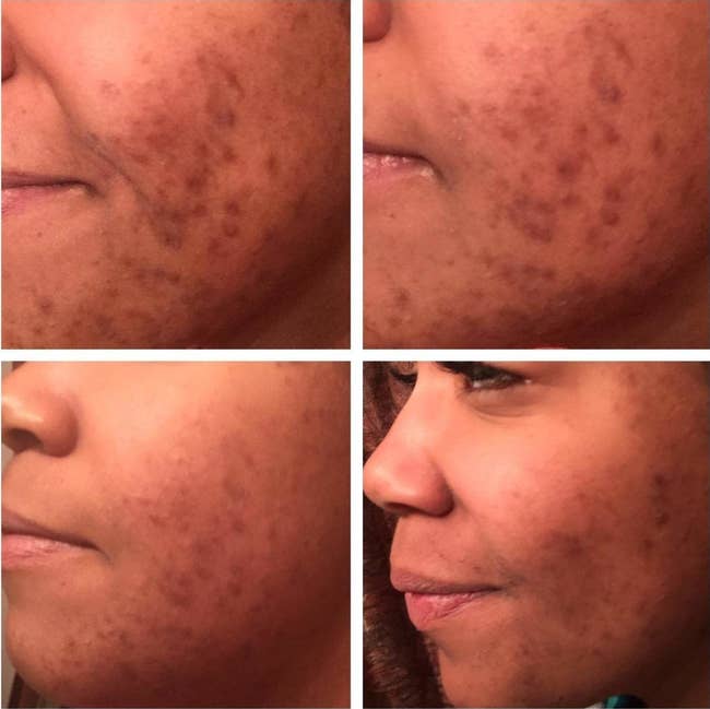 Four images showing a reviewer with healing acne and fading acne marks