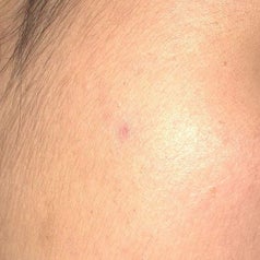 The same reviewer with no more zit, just a small healing mark