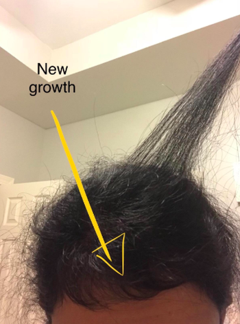 different reviewer showing new hair growth at the front of their head