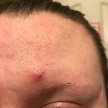 reviewer pic of large inflamed pimple on forehead
