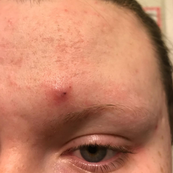 reviewer pic of large, painful looking pimple above eyebrow