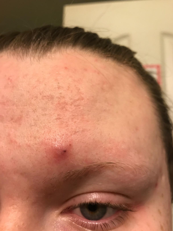 reviewer pic of large, painful looking pimple above eyebrow