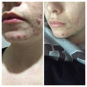 on left, reviewer's chin area covered in acne. on right, same reviewer's chin with less acne after using the clay mask once a week