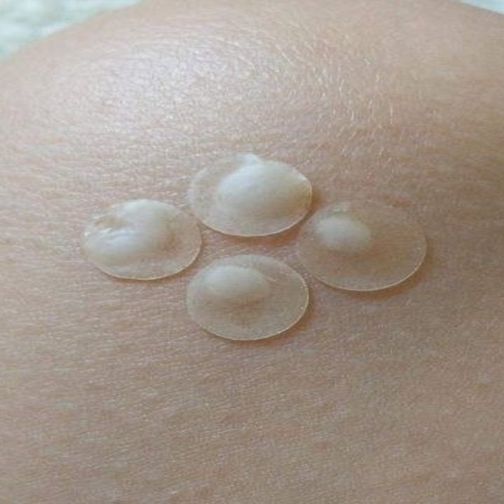 reviewer with four pus-filled Mighty Patches on their kneecap