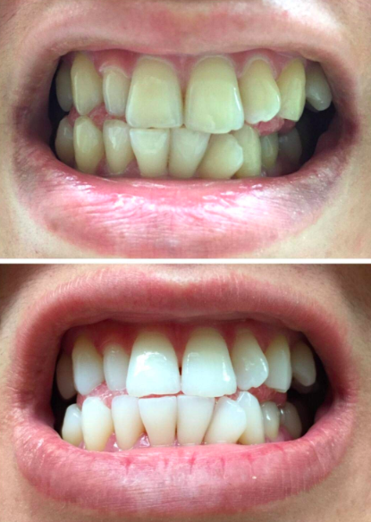 Detector Trappenhuis ontploffen 19 Teeth Whiteners That Work So Well, It's Basically Magic