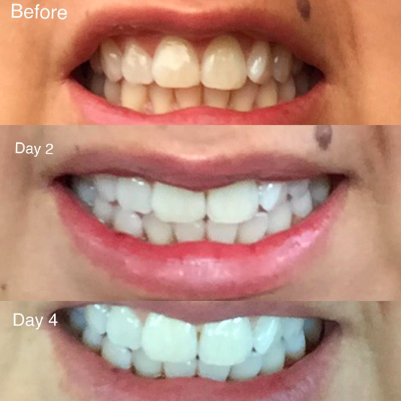 crest charcoal toothpaste results