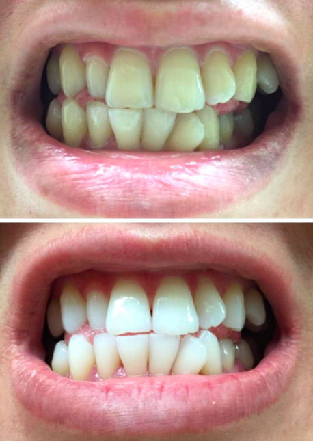 crest white strips professional effects review