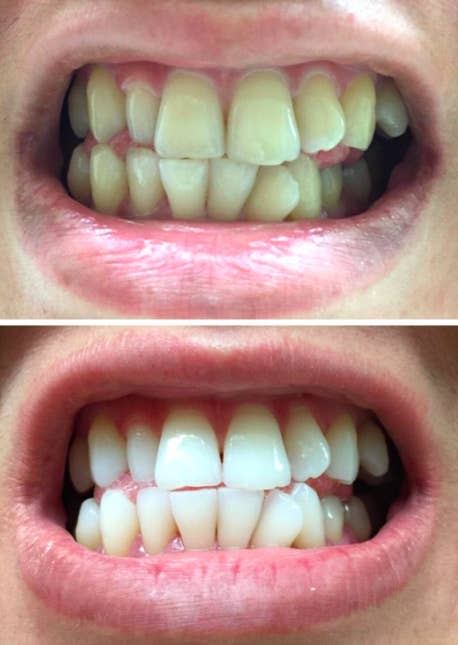 Before and after image of teeth to show how well the strips work