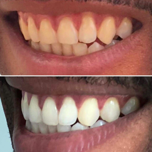 20 Teeth Whiteners That Work So Well, It's Like Magic