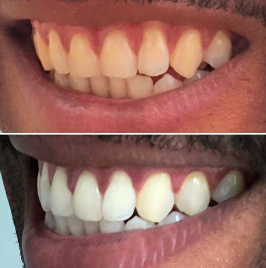 color wheel teeth whitening