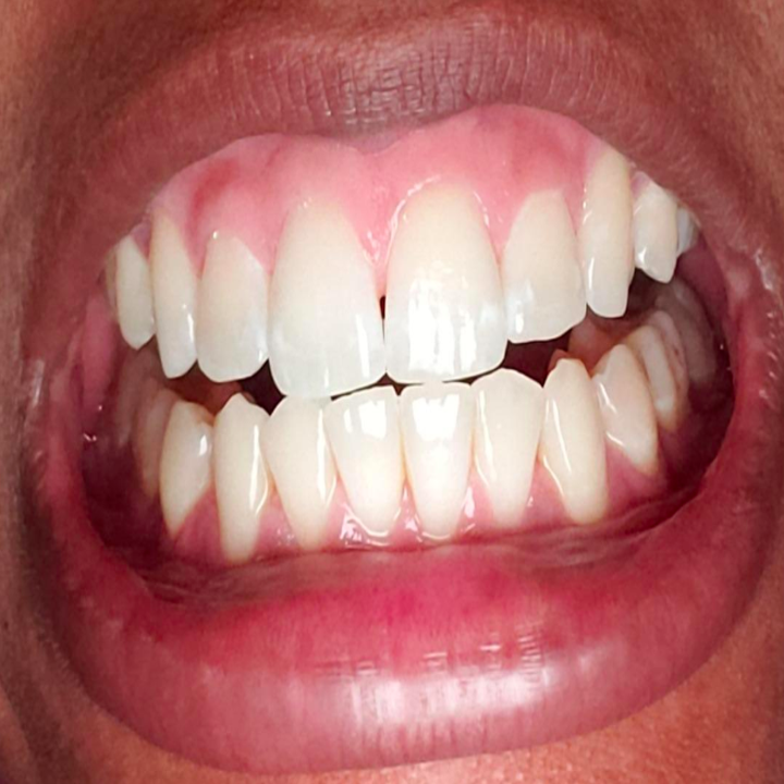 Using teeth whiteners