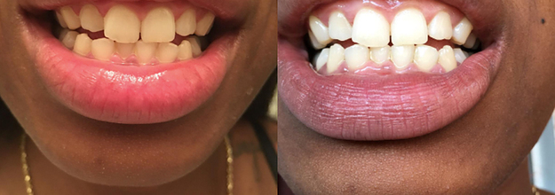 20 Teeth Whiteners That Work So Well It S Like Magic