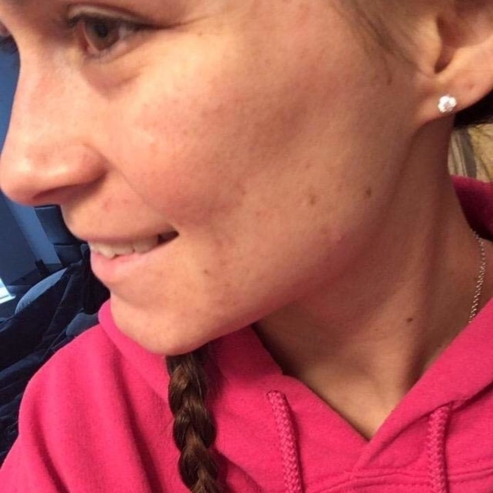 same reviewer's cheek with less acne scars and pimples after using the rosehip seed oil