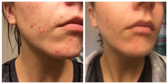 on the left reviewer with many breakouts, on the right the same reviewer with significantly lessened breakouts