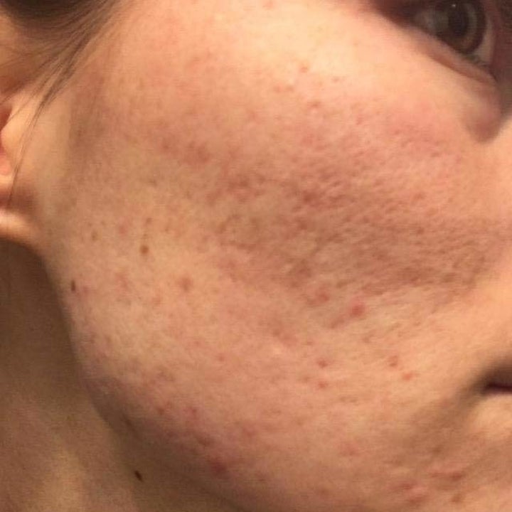 reviewer's cheek covered in acne scars and pimples