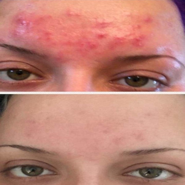 on top, reviewer's forehead with bumpy acne and redness. on bottom, same reviewer's forehead with less acne and red areas after using the acne cleanser