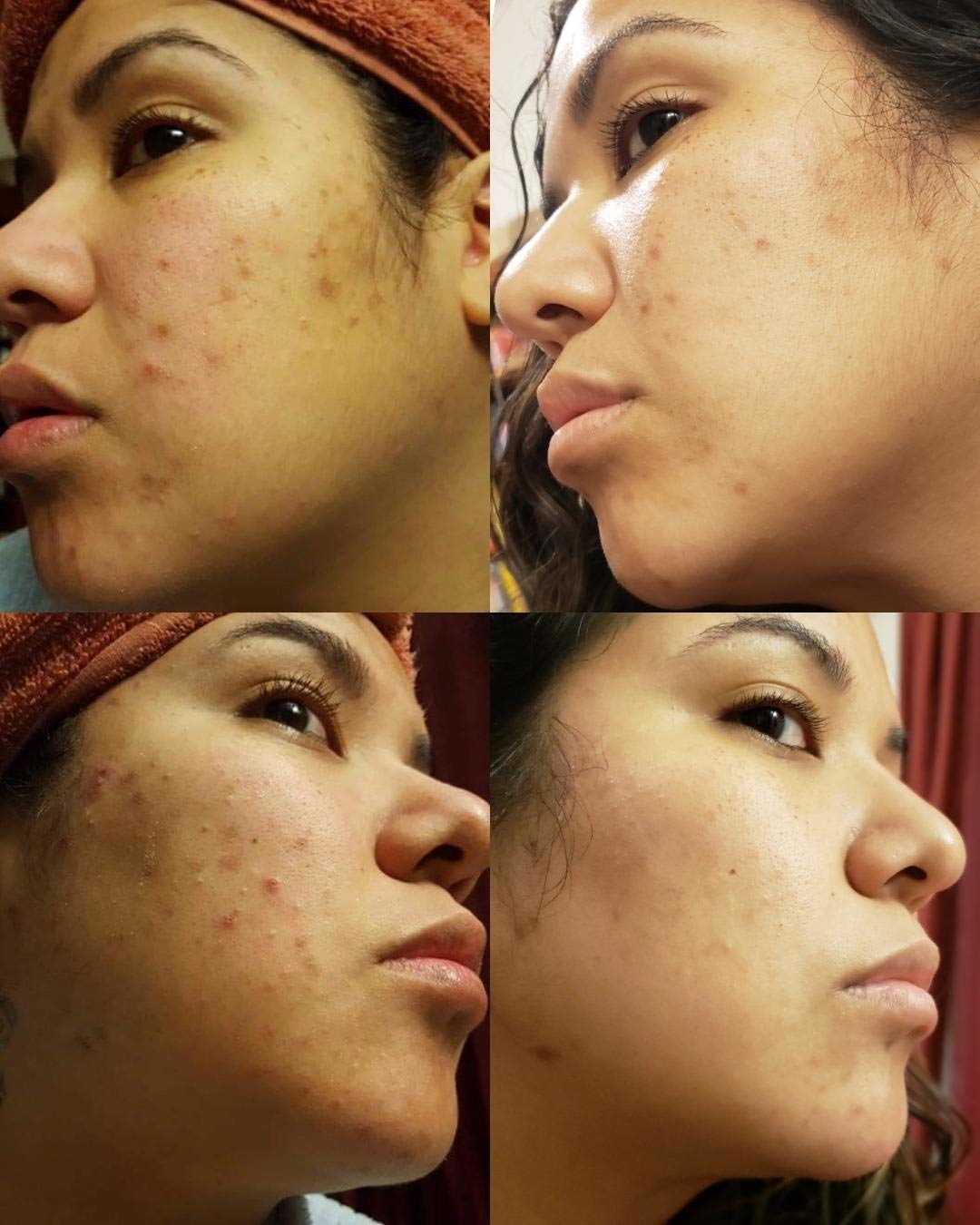 reviewer's cheek with breakouts on top left and bottom left. same reviewer's cheek with less breakouts