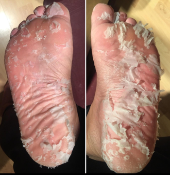 A customer review photo of their feet covered in dead skin