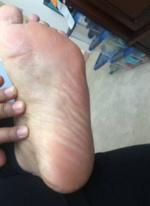 A customer review photo of their feet after the dead skin has come off